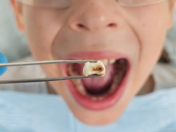 Best Emergency Dentist for Lost Fillings or Crowns in Chesterton, IN